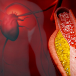 Wie Cholesterinspiegel und Triglyceridwerte mit der Alzheimer-Krankheit zusammenhängen 1