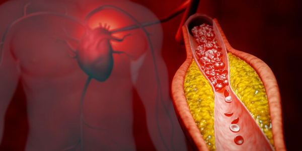 Wie Cholesterinspiegel und Triglyceridwerte mit der Alzheimer-Krankheit zusammenhängen 1